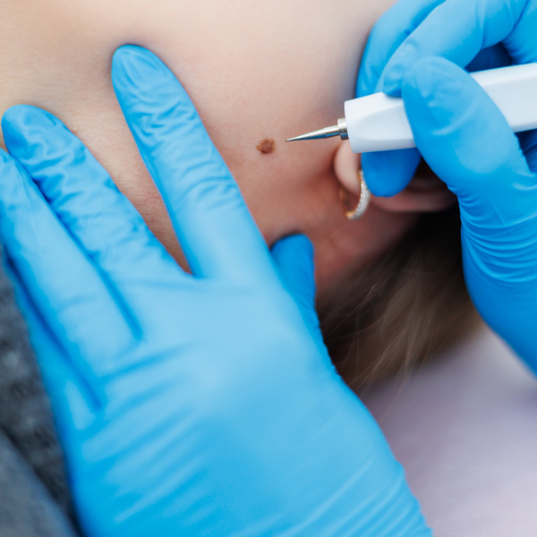 Plasma Fibroblast Treatment